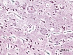 Tiêu bản nhuộm bạc lớp vỏ não của bệnh nhân Alzheimer